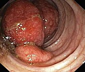 Lymphoma colon tumours,endoscope view