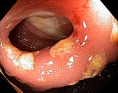 Crohn's disease,endoscope view