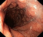 Alcohol-related gastritis,endoscope view