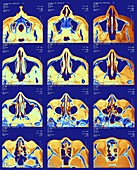 Nose and sinuses,CT scan