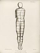 Disinterred 15th-century body,1852