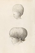 Hydrocephalus in child and adult,1825