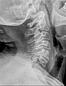 Normal Cervical spine x-ray