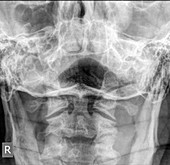 Normal Cervical spine x-ray