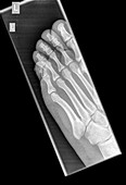 Intermediate phalanx x-ray