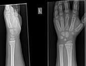 wrist and hand x-ray