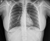 Normal healthy Chest x-ray