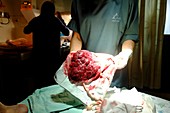 Placenta at the delivery room