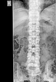 Human Lumbar Spine x-Ray
