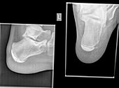 calcaneus (heel bone) X-ray