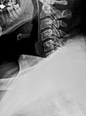 X-ray of a human Cervical spine