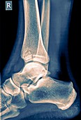 Ankle x-ray