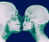 X-ray kissing