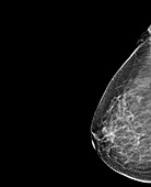 Breast Mammography