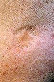 Smallpox vaccination scar