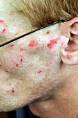 Infected self-inflicted skin lesions