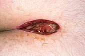 Post-surgery pilonidal sinus wound