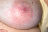 Breast infection