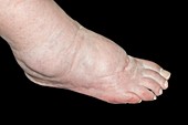 Ankle oedema