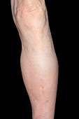 Swollen lower leg
