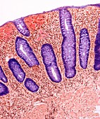 Crohn's disease,light micrograph