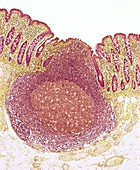 Crohn's disease,light micrograph