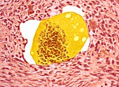 Bone tumour,light micrograph