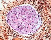 Gliomatosis peritonei,light micrograph