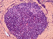 Liver cancer,light micrograph