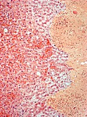 Liver sarcoidosis,light micrograph