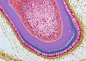 Dermoid ovarian cyst,light micrograph