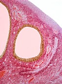 Ovarian cysts,light micrograph
