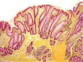 Colorectal polyp,light micrograph