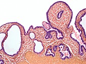 Inflamed fallopian tube,light micrograph