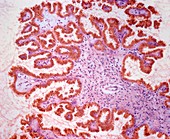 Ovarian tumour,light micrograph