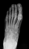 Arthritis of the foot,X-ray