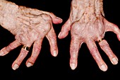 Arthritic hands