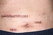 Oesophagectomy scars