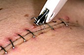 Oesophagectomy suture removal