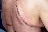Oesophagectomy scar