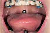 Inflamed tongue after piercing