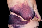 Bruised torso and breast