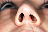 Deviated nasal septum