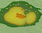 Cancer cell nucleus,TEM