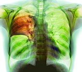 Pulmonary consolidation,X-ray