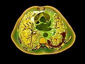 Mesothelioma lung tumour,CT scan