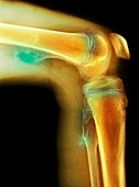 Bone tumour,X-ray
