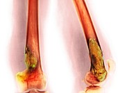 Bone tumour,X-ray
