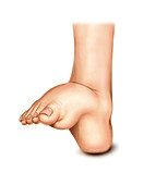 Foot deformations,artwork