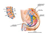 Penile nerve damage due to spinal defect